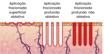 Ilustração dos modos superficiais ablativo, profundo ablativo e profundo não ablativo.